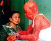 220px-Agent-Orange-dioxin-skin-damage-Vietnam.jpg