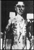 ATOMIC BOMB VICTIM 2.png